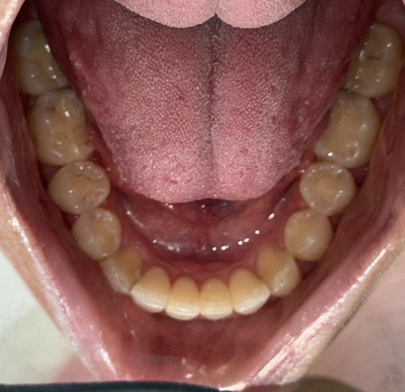 Invisalign clear aligner being placed on teeth