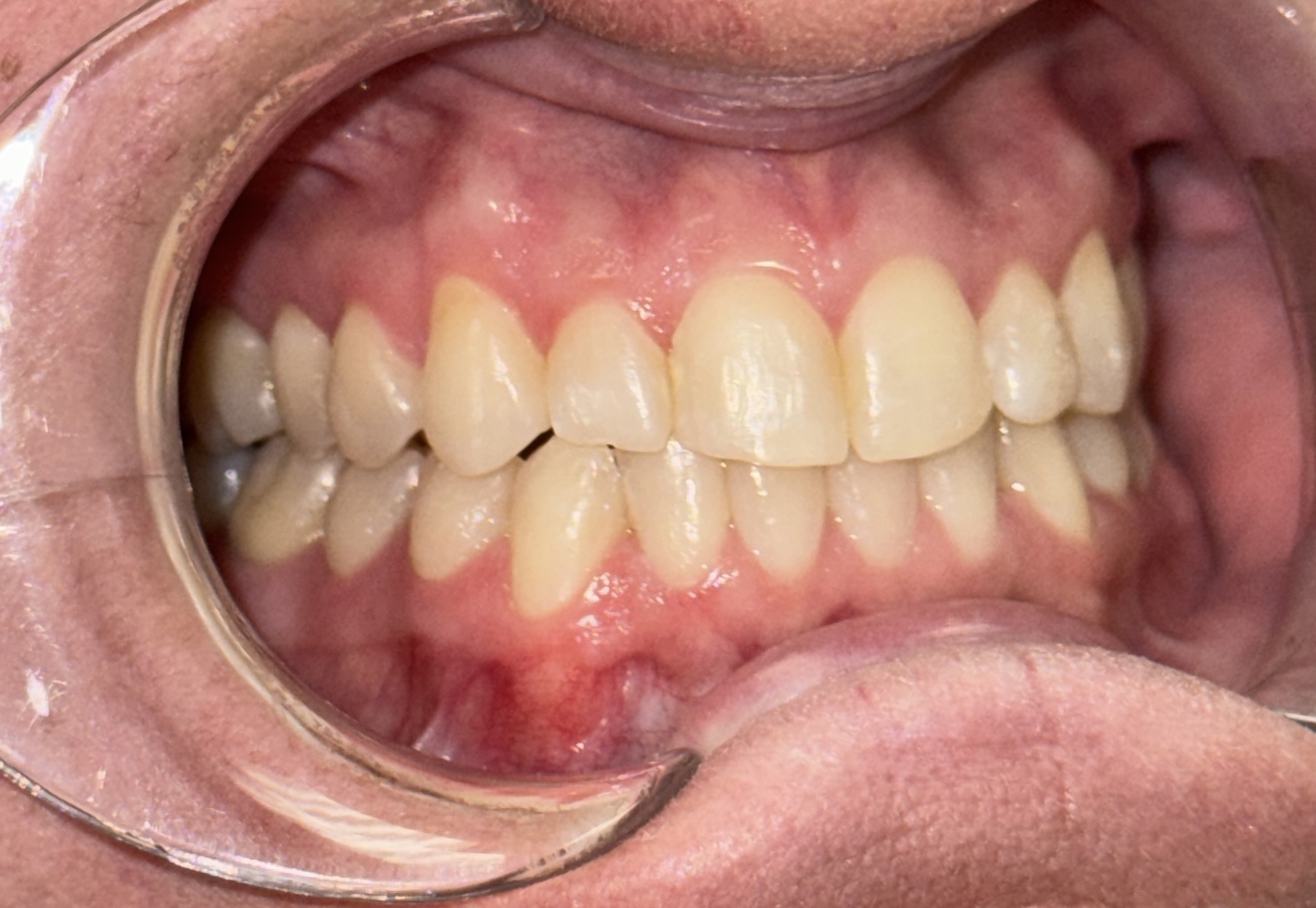 Invisalign Treatment Process