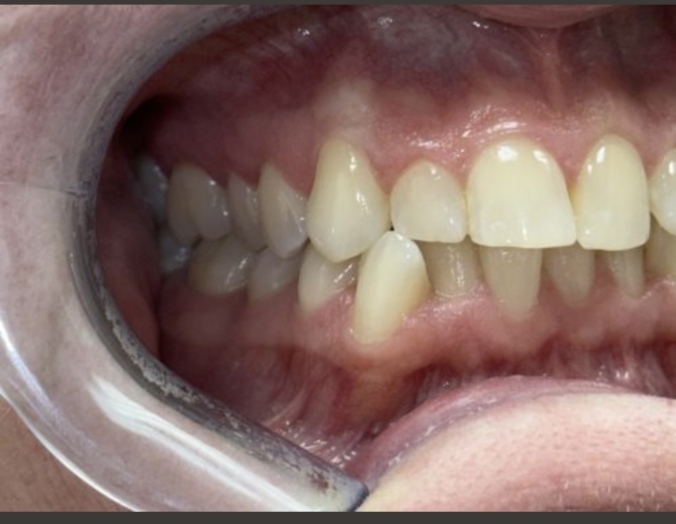 Invisalign Smile Transformation
