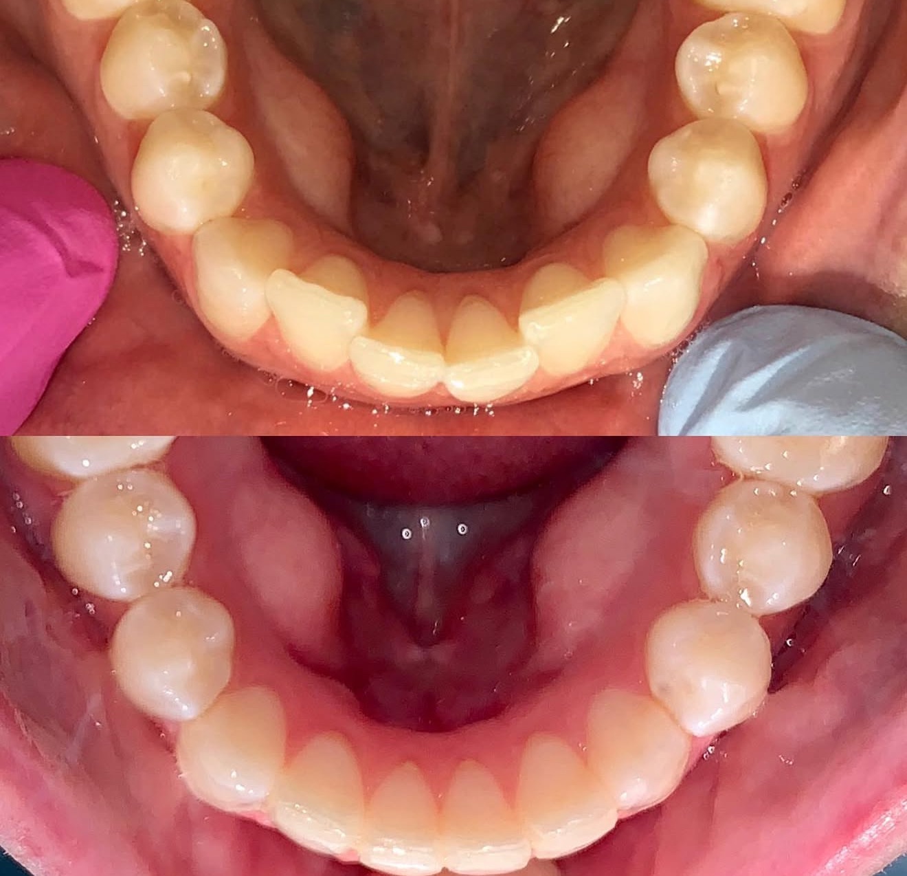 Invisalign Clear Aligner System