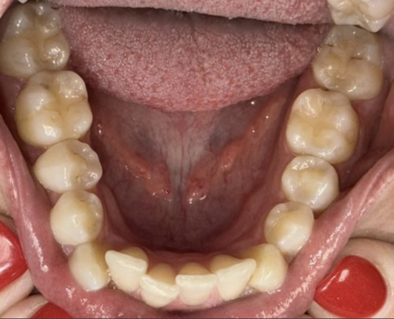 Invisalign Progress