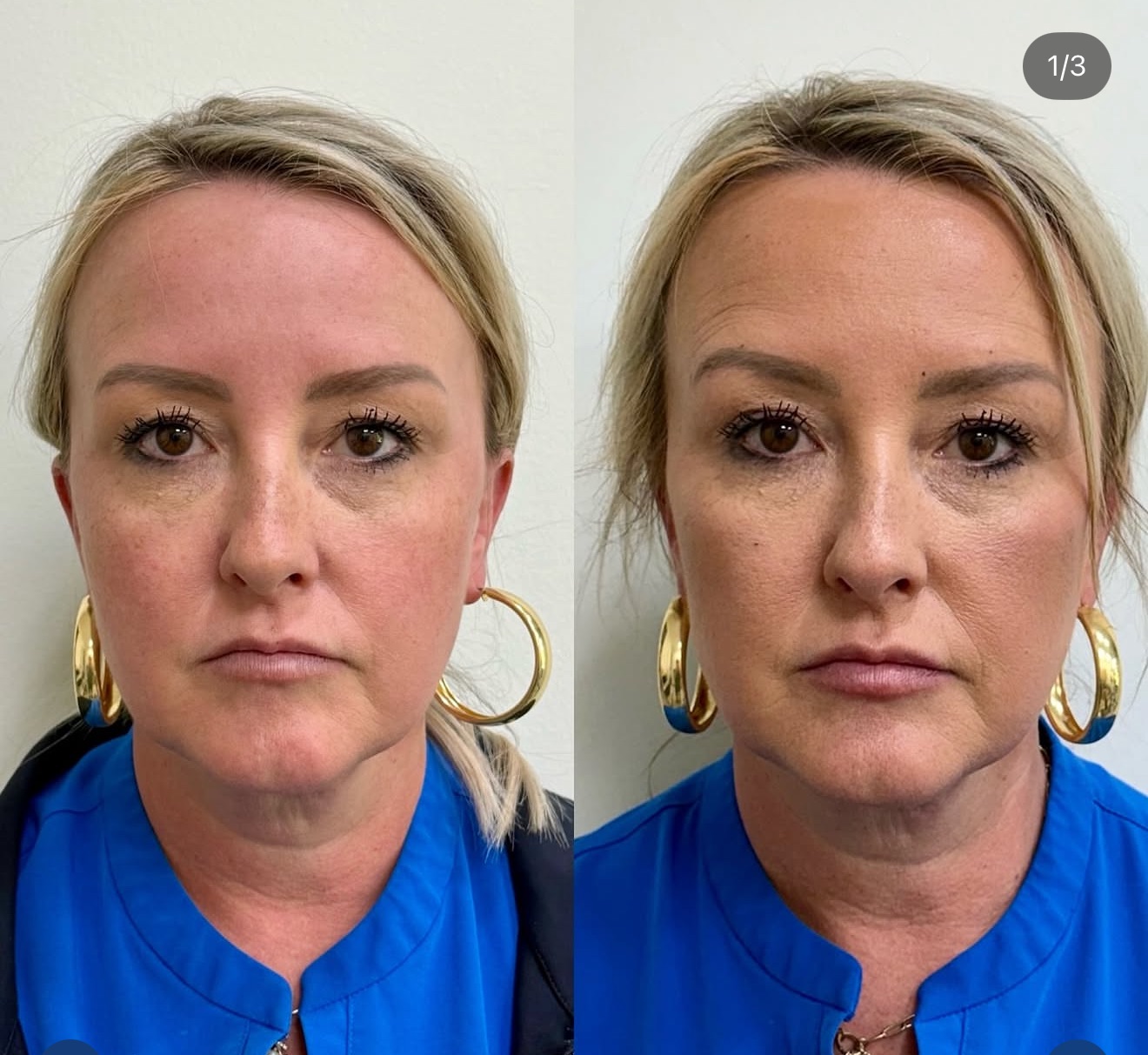 Juvéderm Facial Rejuvenation