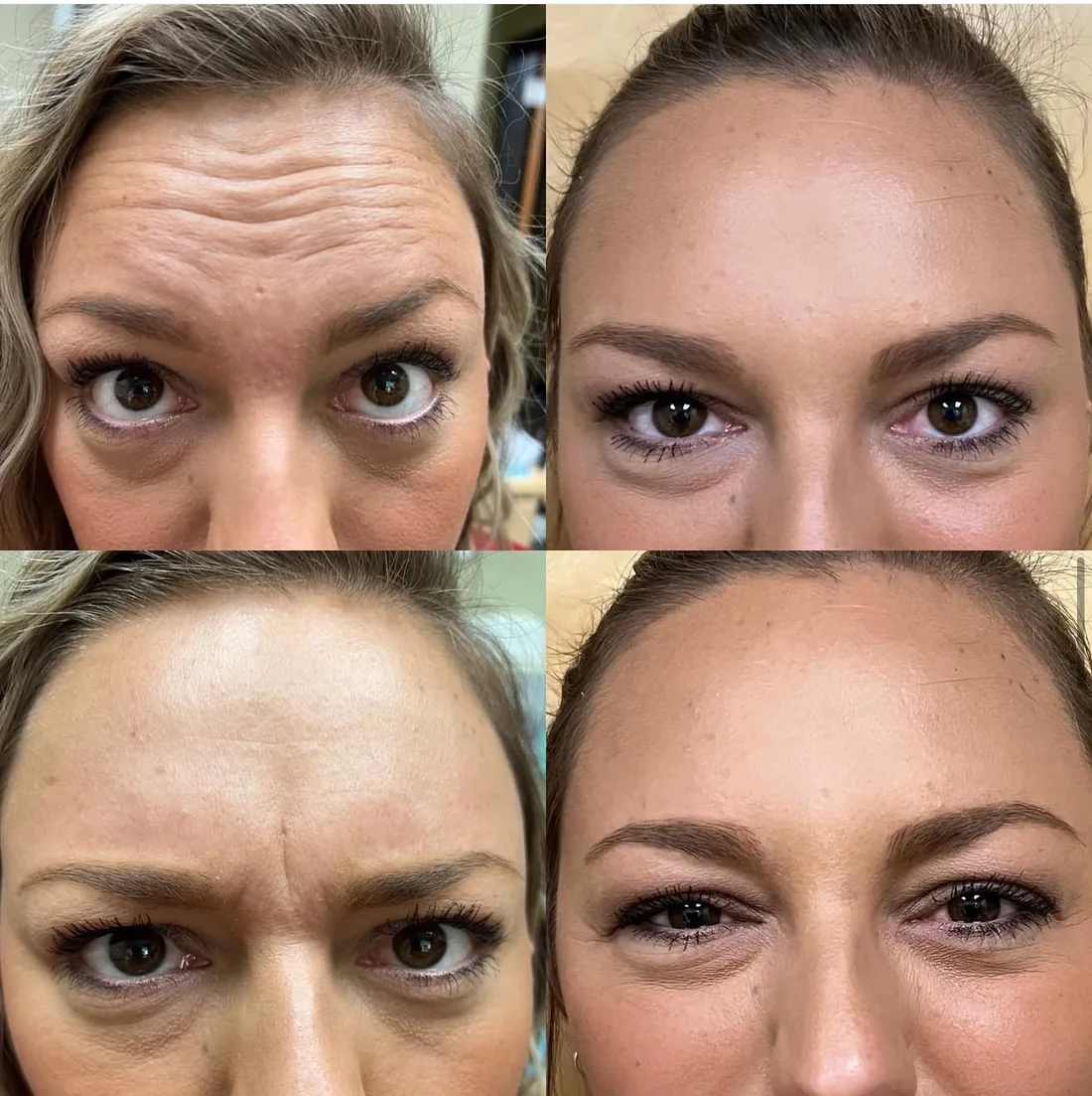 Botox Cosmetic Treatment