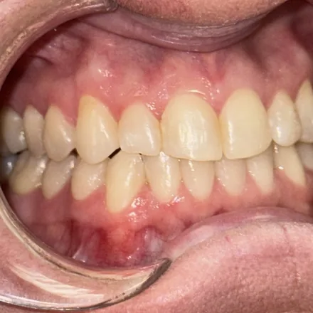 Invisalign Treatment Process