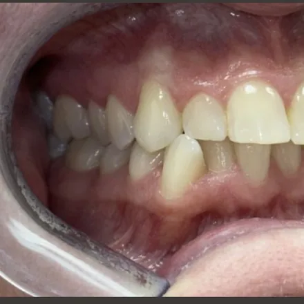 Invisalign Smile Transformation