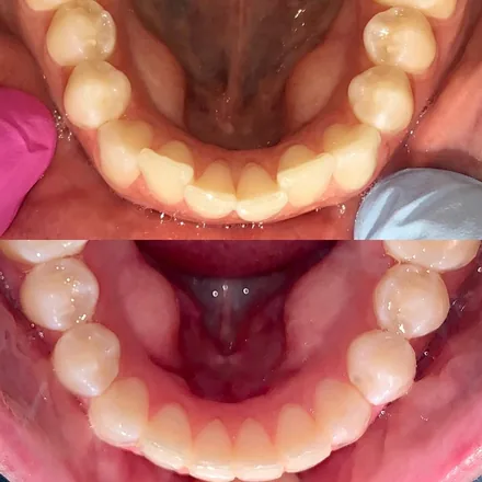 Invisalign Clear Aligner System