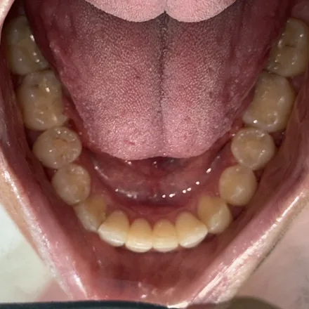 Invisalign Treatment