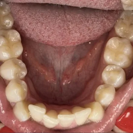 Invisalign Progress