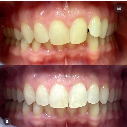 Invisalign Before After