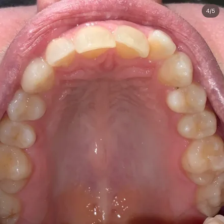 Invisalign Case Study