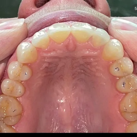 Invisalign Finished Results