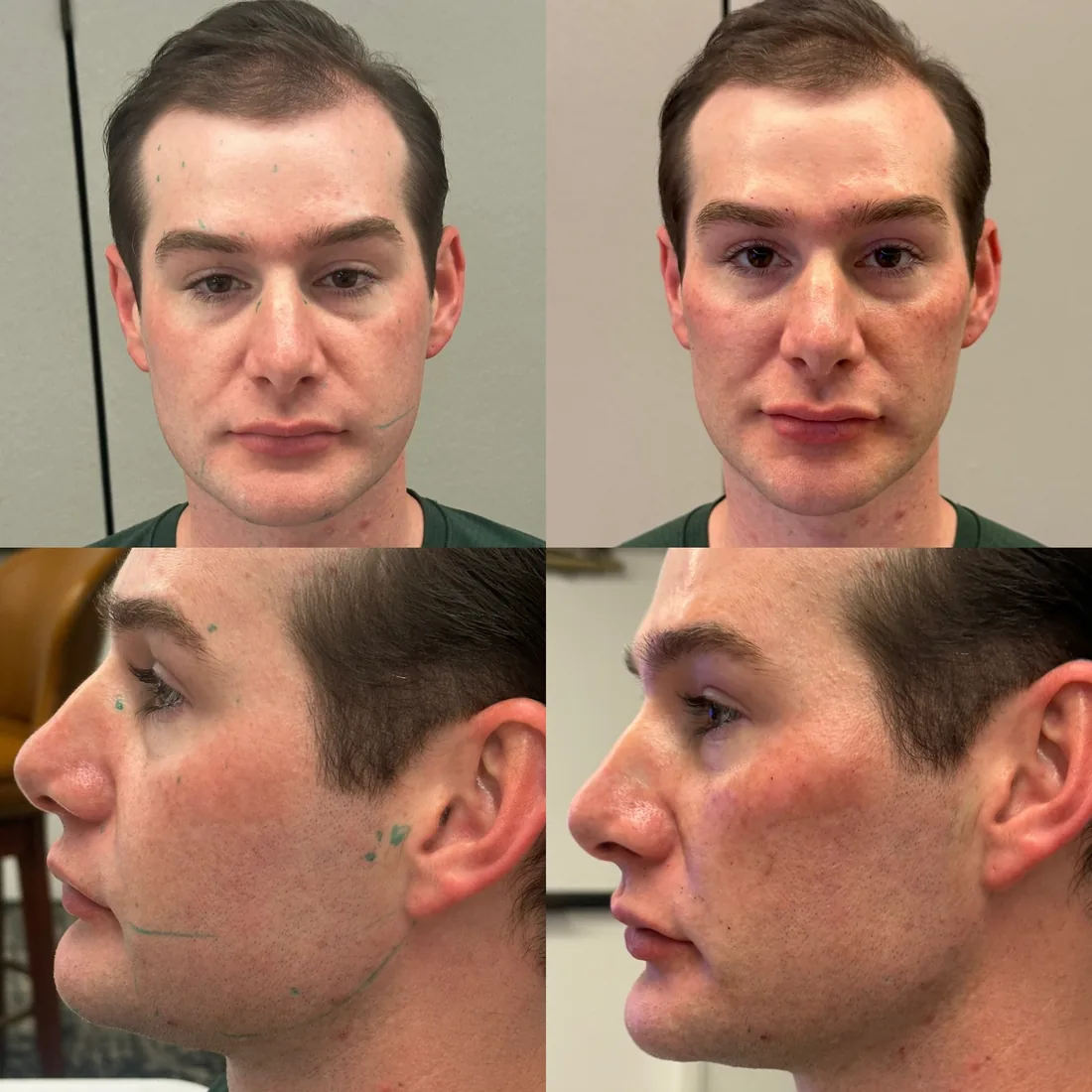 Juvéderm Treatment Results