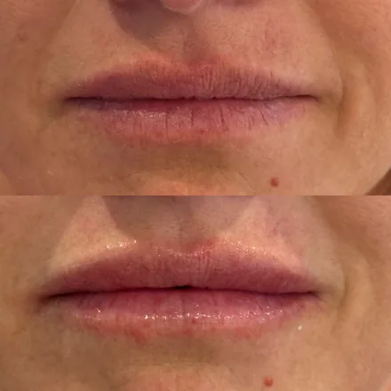 Dermal Filler Before and After