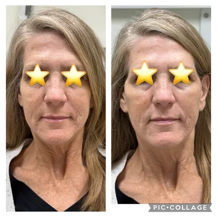 Lip Enhancement