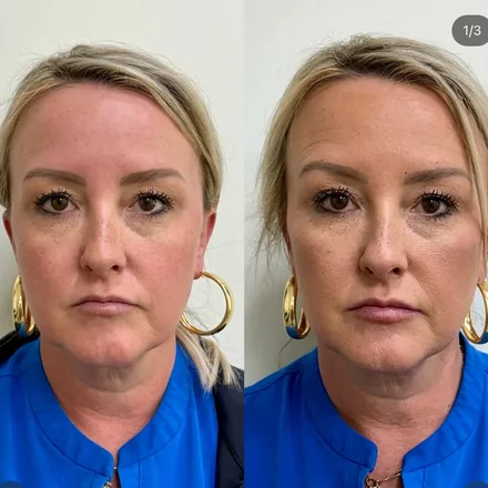 Juvéderm Facial Rejuvenation