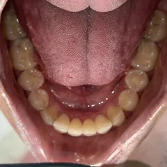 Invisalign clear aligner