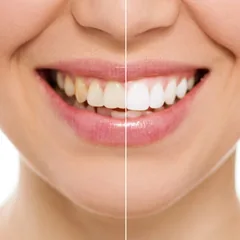 Professional teeth whitening results